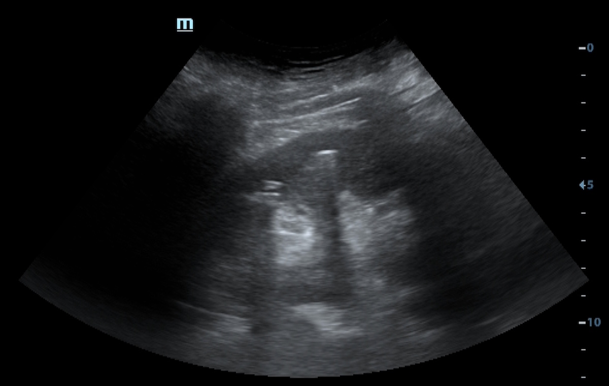 Emphysematous Pyelonephritis