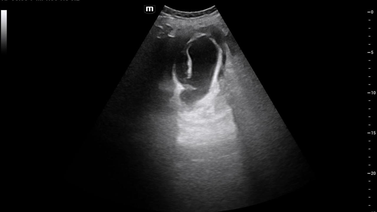 Destructive Acute Cholecystitis with Multiple Abscess Formation